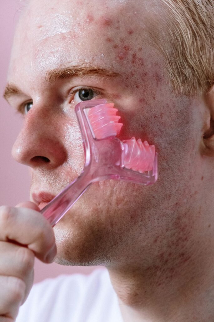 Hình ảnh minh họa: Điều trị mụn bao lâu thì hết? - SkinLab by Dr. Thục