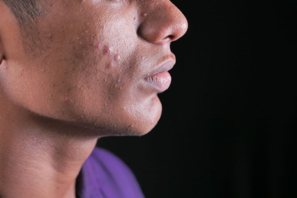 Hình ảnh minh họa: Mụn nội tiết là gì? - SkinLab by Dr. Thục