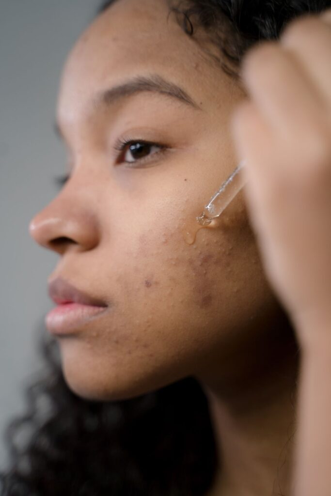 Hình ảnh minh họa: Mụn ẩn dưới da điều trị thế nào? - SkinLab by Dr. Thục