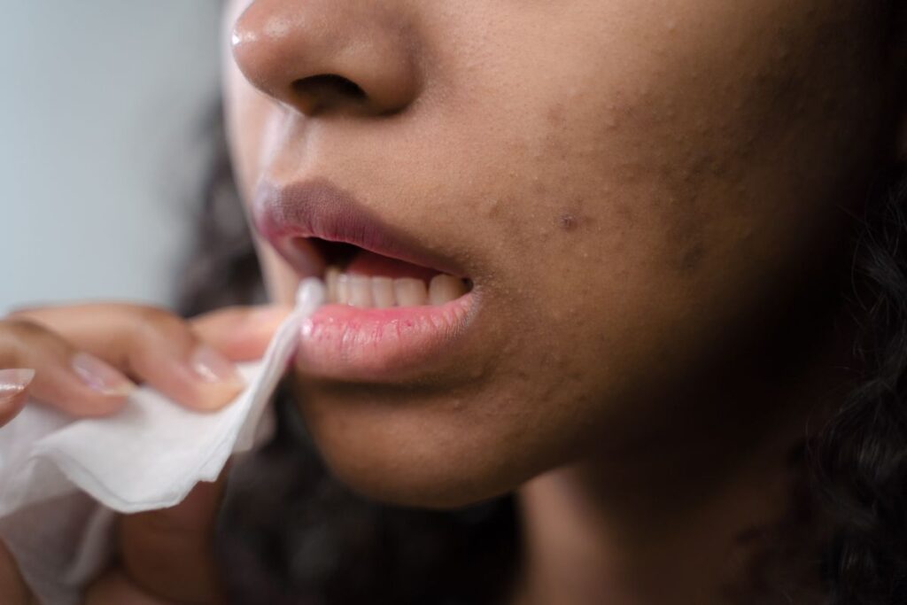 Hình ảnh minh họa: Mụn viêm có nên nặn không? - SkinLab by Dr. Thục