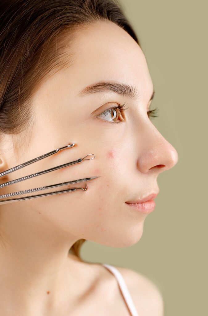 Hình ảnh minh họa: Có nên tự trị mụn tại nhà? - SkinLab by Dr. Thục