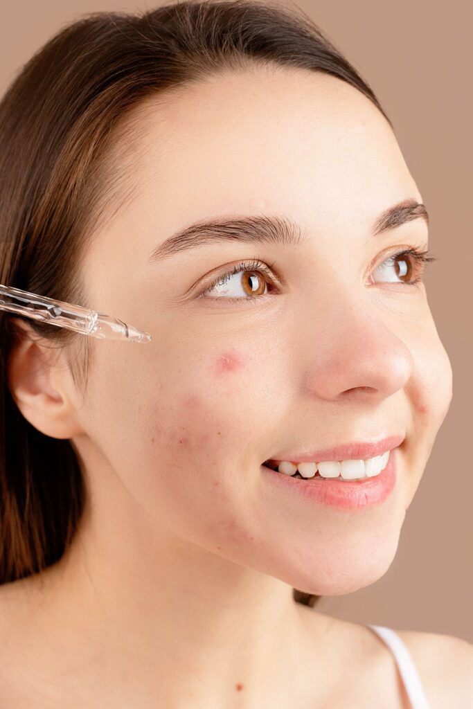 Hình ảnh minh họa: Mụn tuổi dậy thì - SkinLab by Dr. Thục