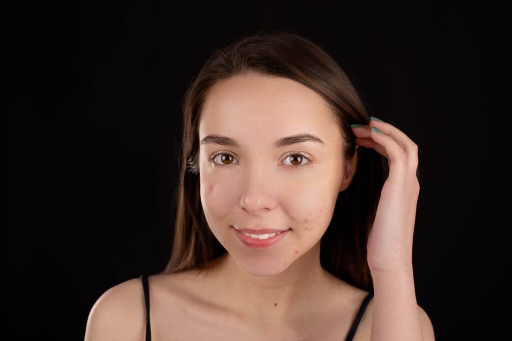 Hình ảnh minh họa: Cách trị thâm đỏ - SkinLab by Dr. Thục