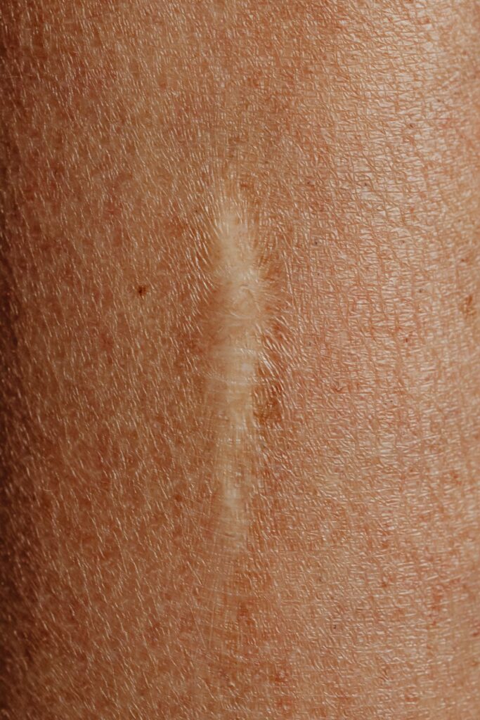 Hình ảnh minh họa: Sẹo rỗ là gì? - SkinLab by Dr. Thục