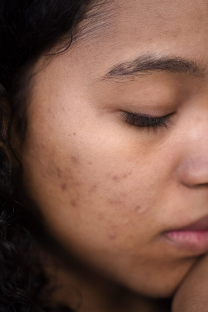 Hình ảnh minh họa: Các loại sẹo rỗ - SkinLab by Dr. Thục