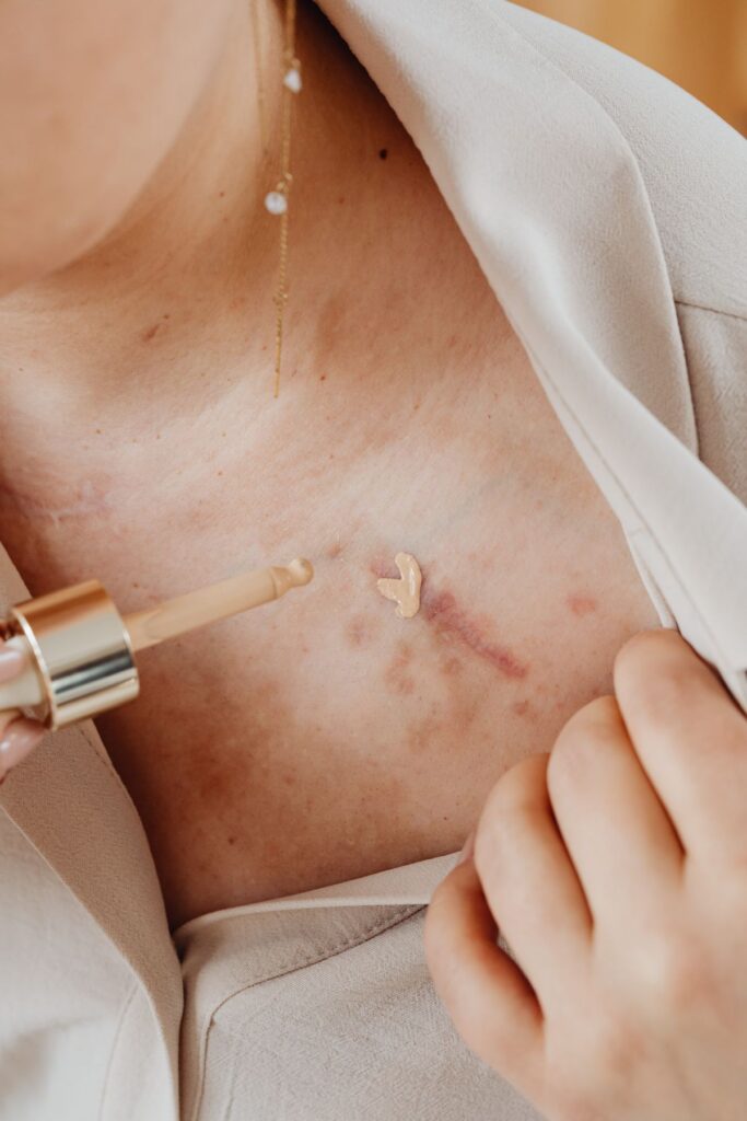 Hình ảnh minh họa: Sẹo rỗ bao lâu cải thiện? - SkinLab by Dr. Thục