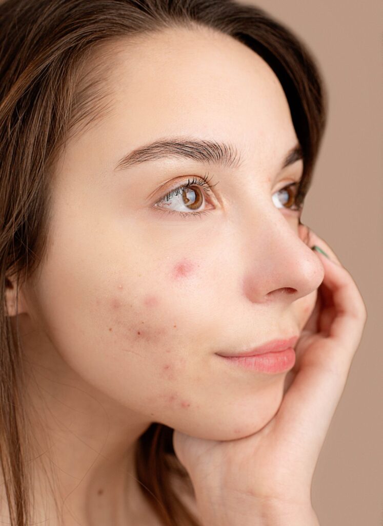 Hình ảnh minh họa: Chi phí trị sẹo rỗ - SkinLab by Dr. Thục