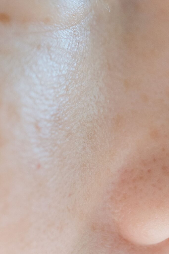 Hình ảnh minh họa: Phân biệt nám và tàn nhang - SkinLab by Dr. Thục
