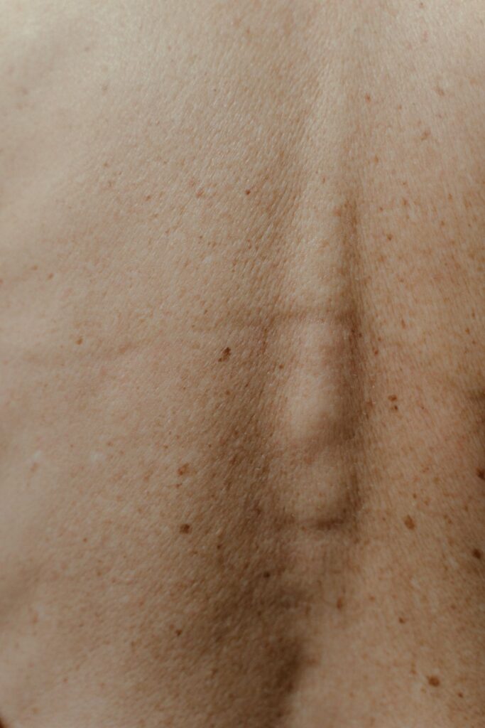 Hình ảnh minh họa: Nám nội tiết - SkinLab by Dr. Thục