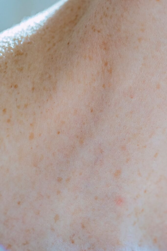 Hình ảnh minh họa: Nám sau sinh - SkinLab by Dr. Thục