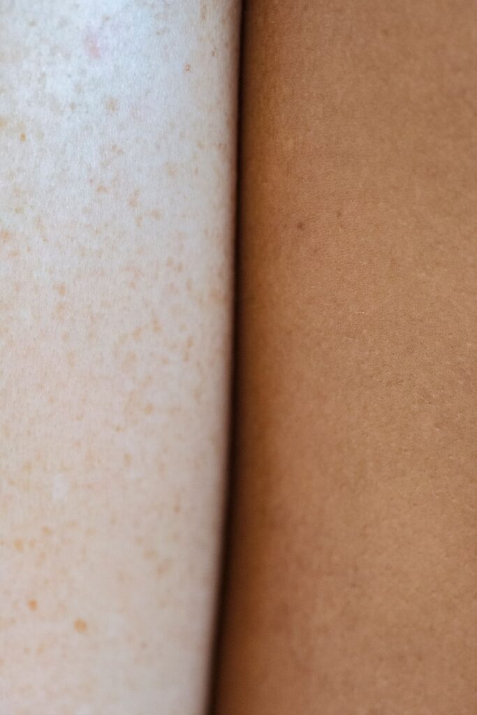 Hình ảnh minh họa: Peel trị nám - SkinLab by Dr. Thục