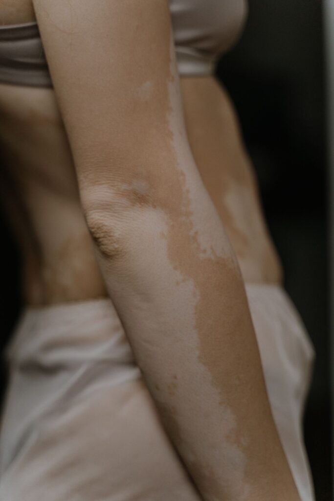Hình ảnh minh họa: Kem trị nám có hiệu quả không? - SkinLab by Dr. Thục