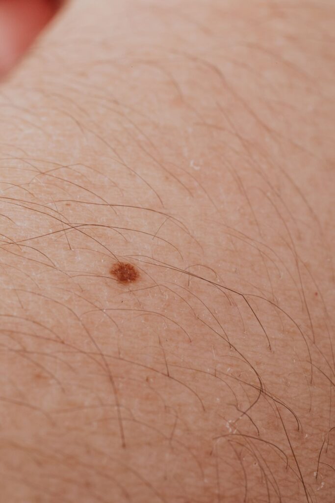 Hình ảnh minh họa: Chàm da - SkinLab by Dr. Thục