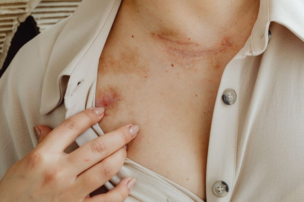 Hình ảnh minh họa: Viêm nang lông - SkinLab by Dr. Thục