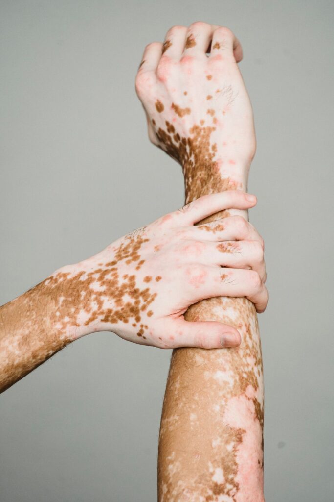 Hình ảnh minh họa: Mề đay - SkinLab by Dr. Thục